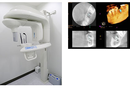 歯科用CT(3Dレントゲン)